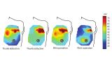 Targeted Muscle Reinnervation Heat Map